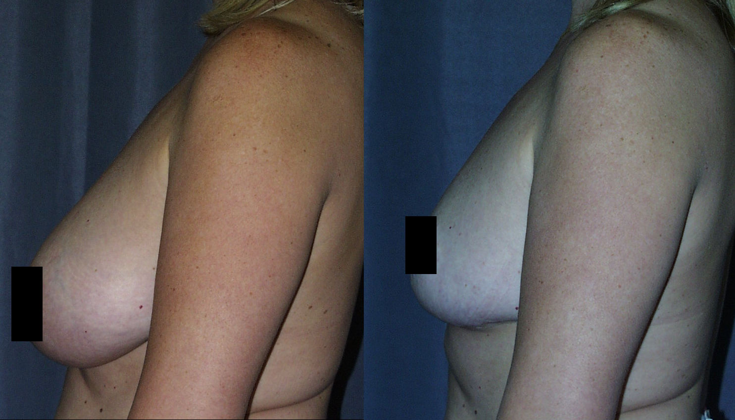 Breast Reduction Before and After Pictures Side View