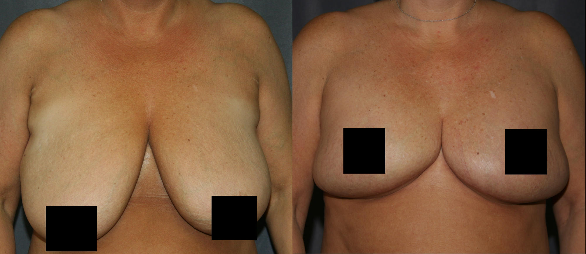 Breast Reduction Before and After 1