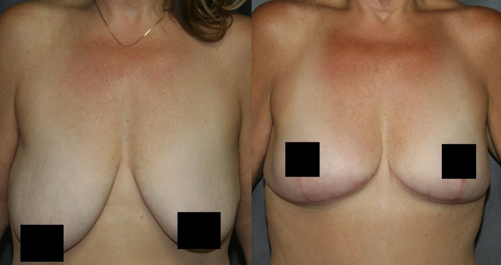 Breast Lift for Smaller Breasts