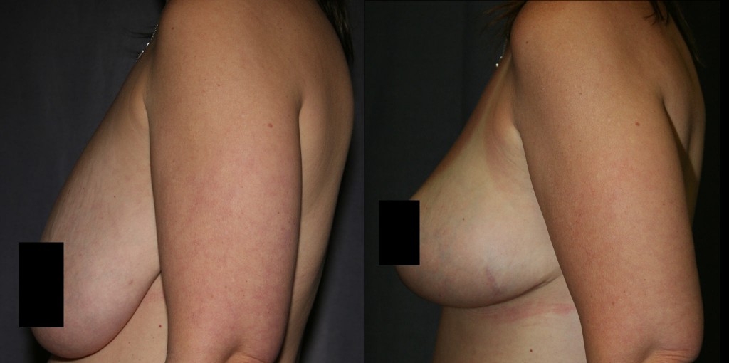 Mastopexy Before and After Pictures - Side View (Breast Lift)