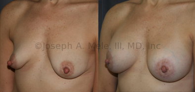 Breast Augmentation with a Periareolar Lift Before and After Pictures: Periareolar lifts are often used to both lift the nipple and to reshape tubular breasts during breast augmentation.