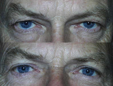 Before upper blepharoplasty and levator advancement (muscle tightening), ptosis (sagging) of the upper eyelids is blocking the patient's vision. He underwent reconstructive plastic surgery to tighten the muscles that elevate the eyelid and raise the upper eyelid's edge above the pupils.