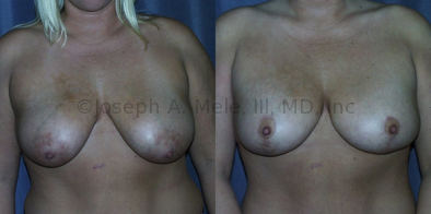 Vertical breast lift before and after pictures show how the lift elevates the breasts and the nipple and reduces the areolae more effectively than the periareolar lift can.