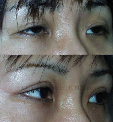 Asian eyelid surgery often includes the formation of a more distinct eyelid crease called the palpebral fold.