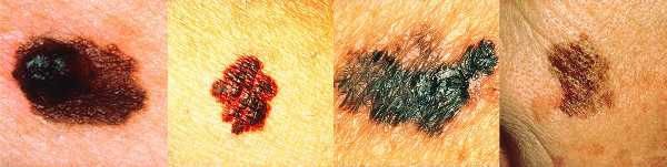 Each melanoma above depicts a typical finding. From left to right they are: A) Asymmetry; B) Borders that are irregular and not smooth; C) Colors that vary from red, white to blue; D) Diameter that is large or increasing in size.