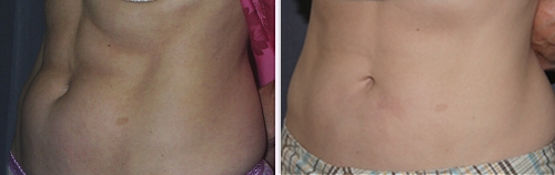 Liposuction of the Abdomen - Before (Left) / After (Right)