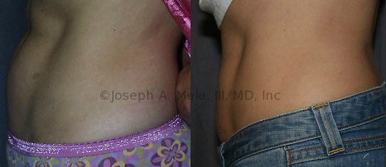 Liposuction - Before and afters show the removal of disproportionate abdominal fat, and delineation of the abdominal muscles.