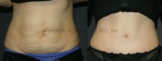 Abdominoplasty provides tighter skin and muscles after pregnancy or weight loss.