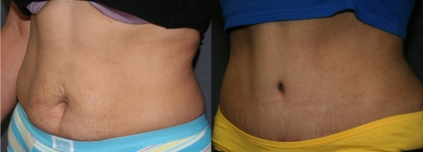 Abdominoplasty / Tummy Tuck: Before and afters show flattening of the abdomen from top to bottom, with removal of lower abdominal fat and tightening of both skin and muscles.