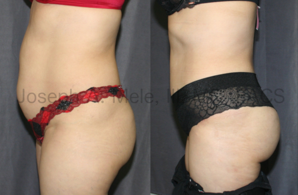 The patient above has very little excess skin and fat; however, her muscles are stretched out of shape. A Tummy Tuck was performed to tighten her abdominal wall, like an internal corset. Also, the available fat she had was used to reshape her buttocks with a Brazilian Butt Lift.