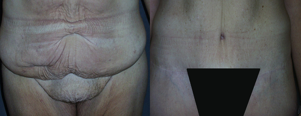 The FUPA (fat upper pubic area) is the excess fullness located above the pubic region and below the excess belly skin. If not addressed at the time of a Tummy Tuck, this excess skin can be a continued source of annoyance and embarrassment.