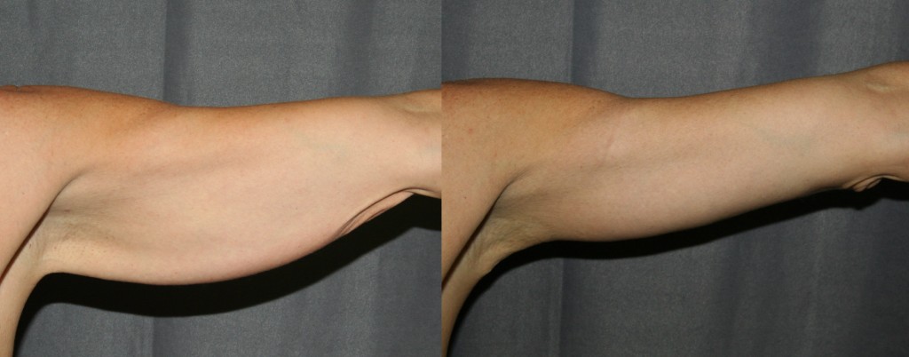 Brachioplasty Before and After (Arm Lift)