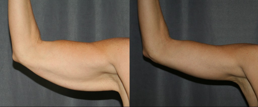 Arm Lift Before and After (Brachioplasty)