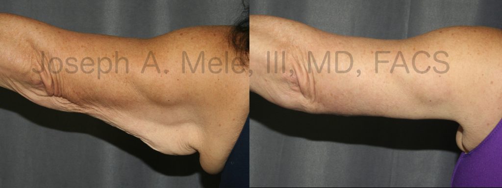 The above Arm Lift before and after pictures demonstrate how careful scar placement enhances the results. In this case, the excess skin was removed using a scar that runs from the inside of the elbow to the back of the armpit. Even with the elbow rotated backward, the scar is still hidden along the lower border of the arm.