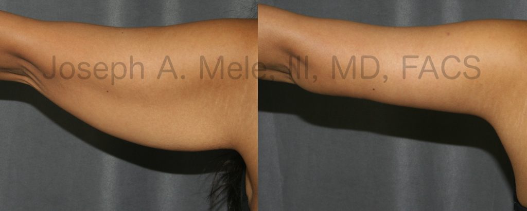 The above Arm Lift Before and After Photos demonstrate what a Brachioplasty can do. Excess skin is removed, leaving the arm tight, firm and with a more muscular contour.