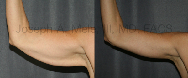 Brachioplasty or Arm Lift Before & After results. Before there is a plethora of excess arm skin. After the upper arm stops waving when the hand does, and a very happy patient.