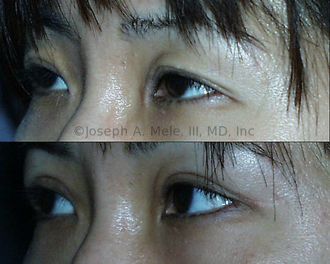 Asian Eyelid Surgery can include refining an ill-defined eyelid crease in addition to removing upper eyelid skin redundancy and lower eyelid bags.