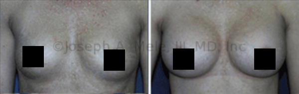 Breast Augmentation Before and After - Front View