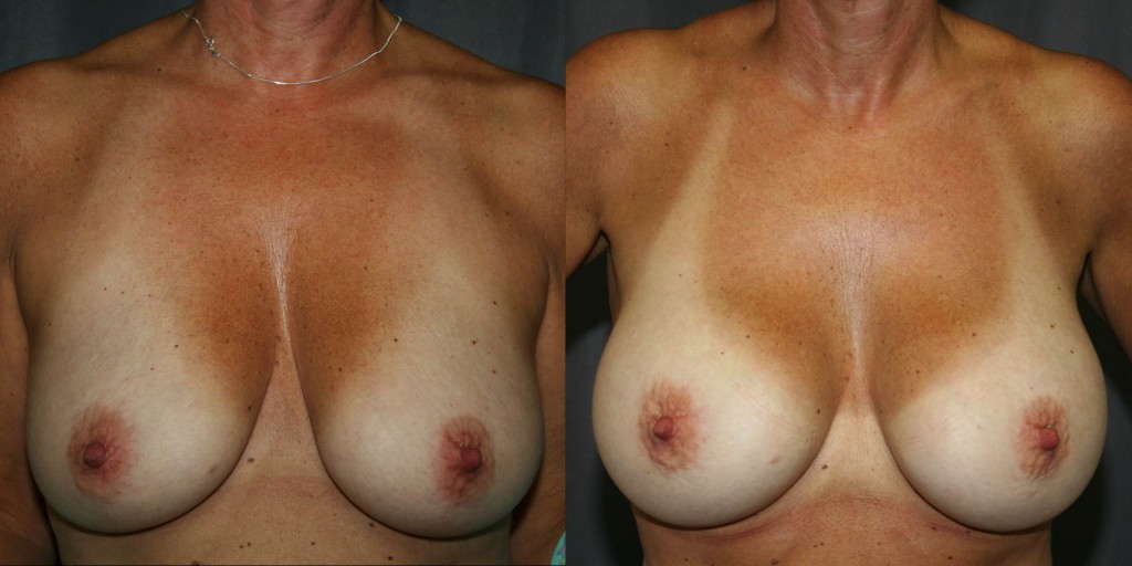 Breast Augmentation Before and After