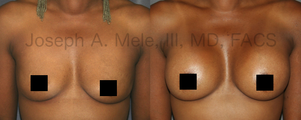 Breast Augmentation before and after pictures - front view African-American woman