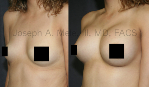 Breast Augmentation Before and After Pictures