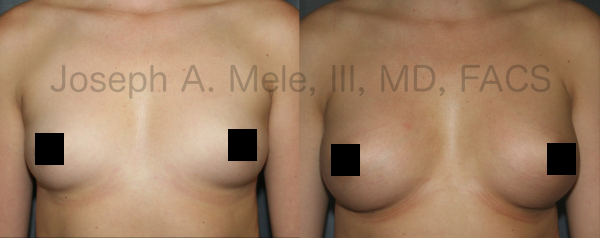 Breast Augmentation Before and After - Front View