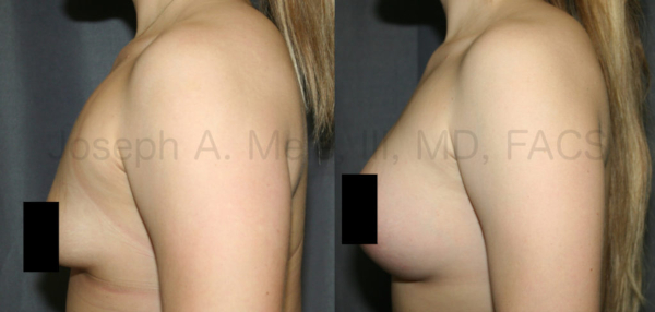 Tubular Breast Augmention Before and After Pictures