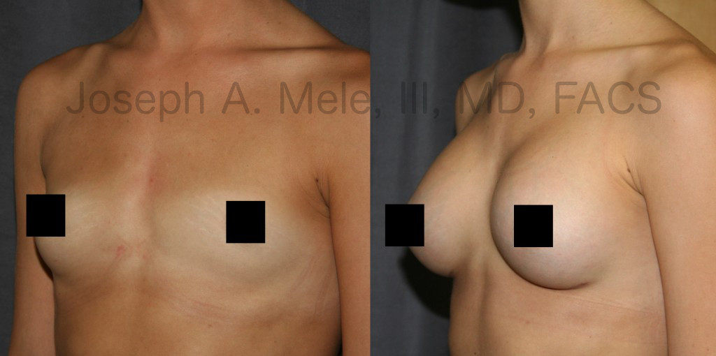 Choosing the right size for you is the most important aspect of Breast Augmentation.