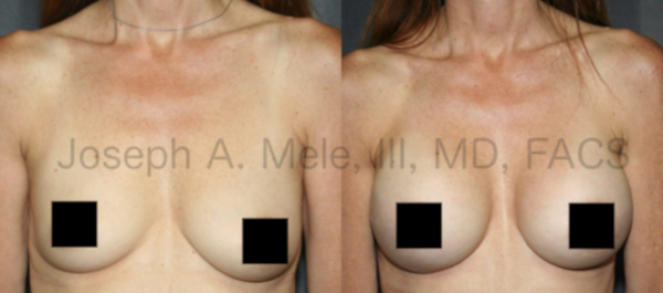 Breast Augmentation before and after pictures for Breast Asymmetry