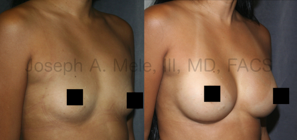 Breast Augmentation with Breast Implants Before and After Photos