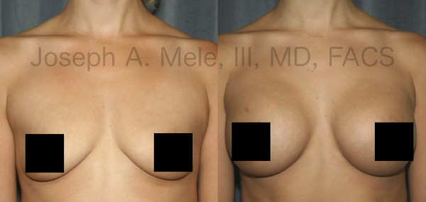 Breast Augmentation Before and After Pictures