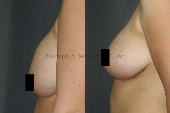 Breast Augmentation Revision can lift the breasts back onto their Breast Implant after postpartum sagging causes them to fall down.