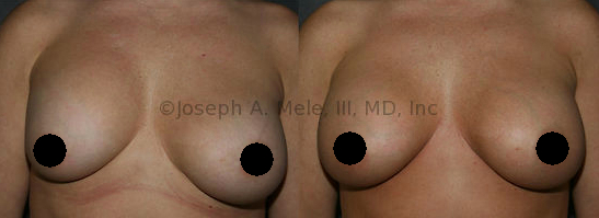 Capsular Contracture release can improve the feel and location of the Breast Implant.