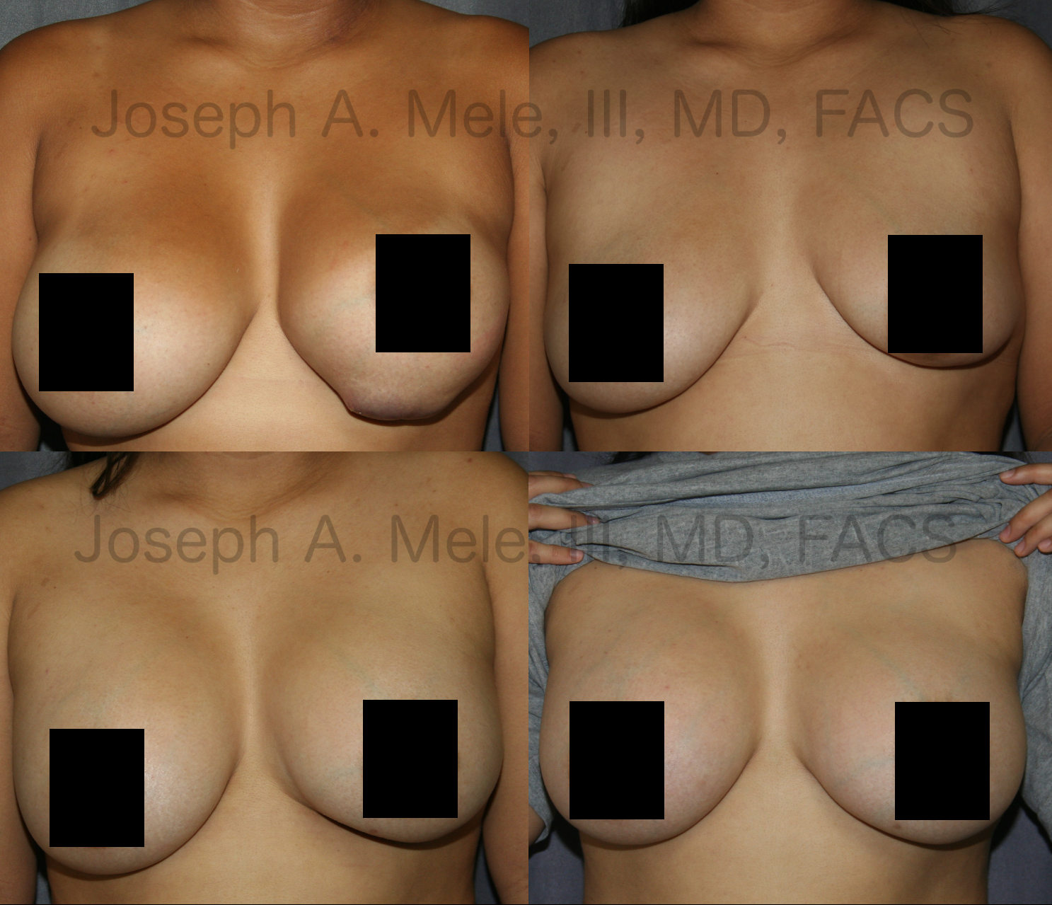 Breast Implant Revision: Sometimes breast implant revision is urgent. The square shape sticking out of the bottom of this patient's left breast is her breast implant, and it's about to fall out.