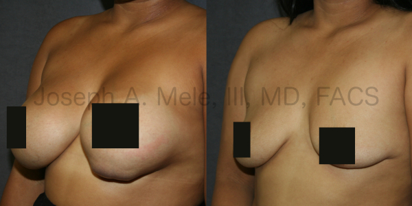 Breast Implant Removal for impending breast implant exposure Before and After Pictures - Front View