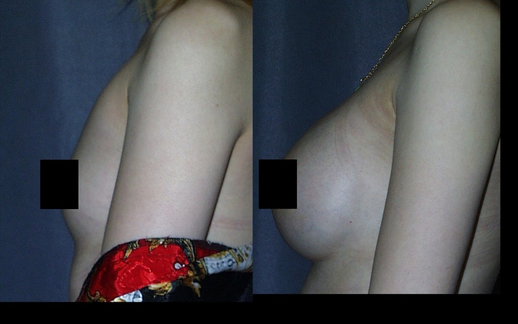 Submuscular Breast Augmentation with Smooth Round Breast Implants