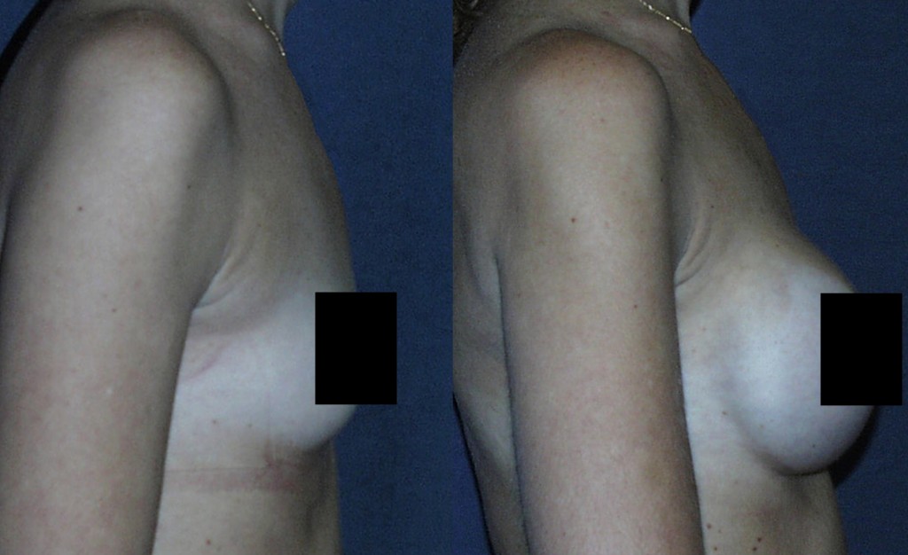 Submuscular Breast Augmentation with thin "soft tissue" coverage.