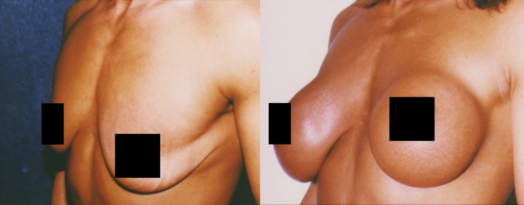 Submuscular Breast Augmentation with Round Breast Implant (Thin Coverage) Before and After Pictures