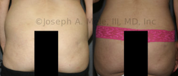 The Brazilian Buttocks Lifts is again the fastest growing cosmetic plastic surgery procedure. Significant improvement in the size and shape of the buttocks is possible by removing disproportionate fat from other areas, the lower back in this example, and selectively inserting the excess fat into the buttocks.