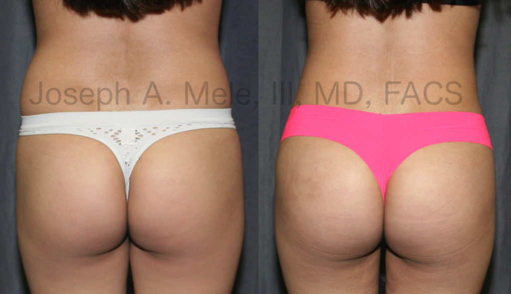 In the above BLL patient, fat was removed from the lower back, flanks and thighs and was injected into the buttocks. 