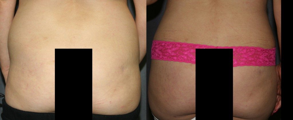 The Brazilian Butt Lift adds volume to the buttocks. Liposuction is used to remove the disproportionate fat from the lower back, and then the fat is transplanted into the buttocks to form more shapely buttocks.