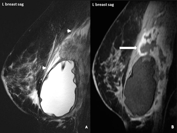 An advanced case of BIA-ALCL. Arrows on this MRI point to white patches of increased fluid around the tumor cells.