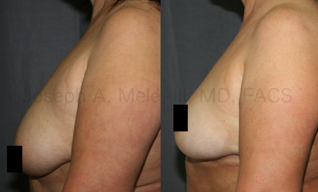Inverted-T or Anchor Breast Lift Before and After Pictures: This type of lift allows for maximum rejuvenation. Tired old looking breast become youthful and perky. The IMF incision is hidden in the fold under the breast. Out of site. Out of mind.
