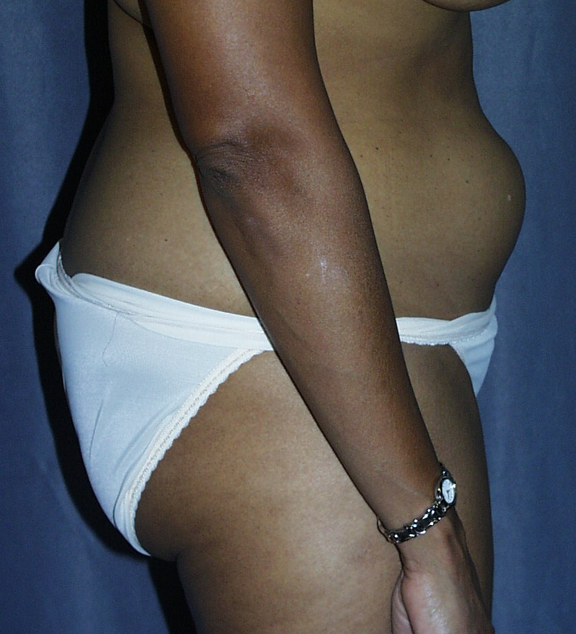 The "infamous" before Tummy Tuck picture at 46-years-old.