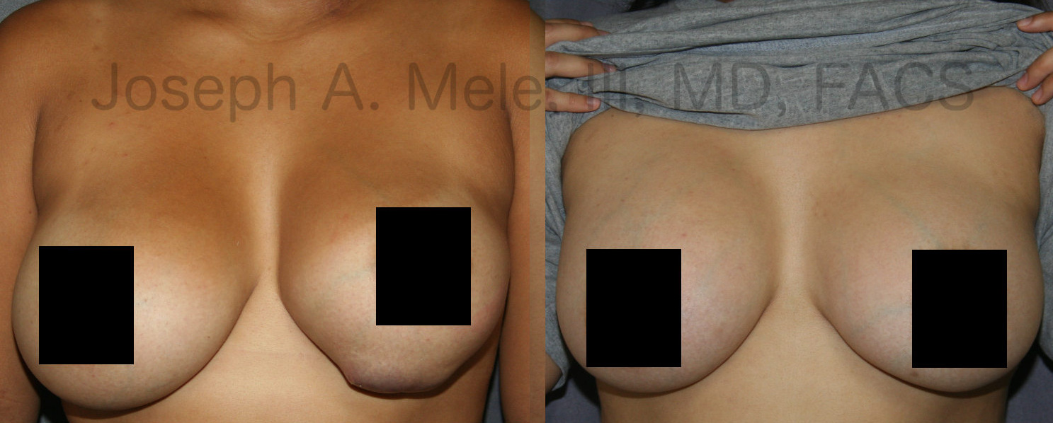 Breast Implant Revision Before and After Photos - the left picture is how the patient initially presented. The second picture is a few months after completion of both stages (breast implant removal and breast implant replacement with pocket modifications).