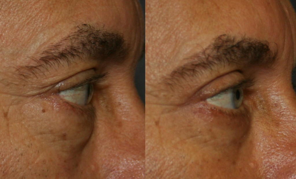 While upper eyelid surgery removes hooding, lower eyelid surgery removes bags. The post-operative appearance is alert and rested and still you.
