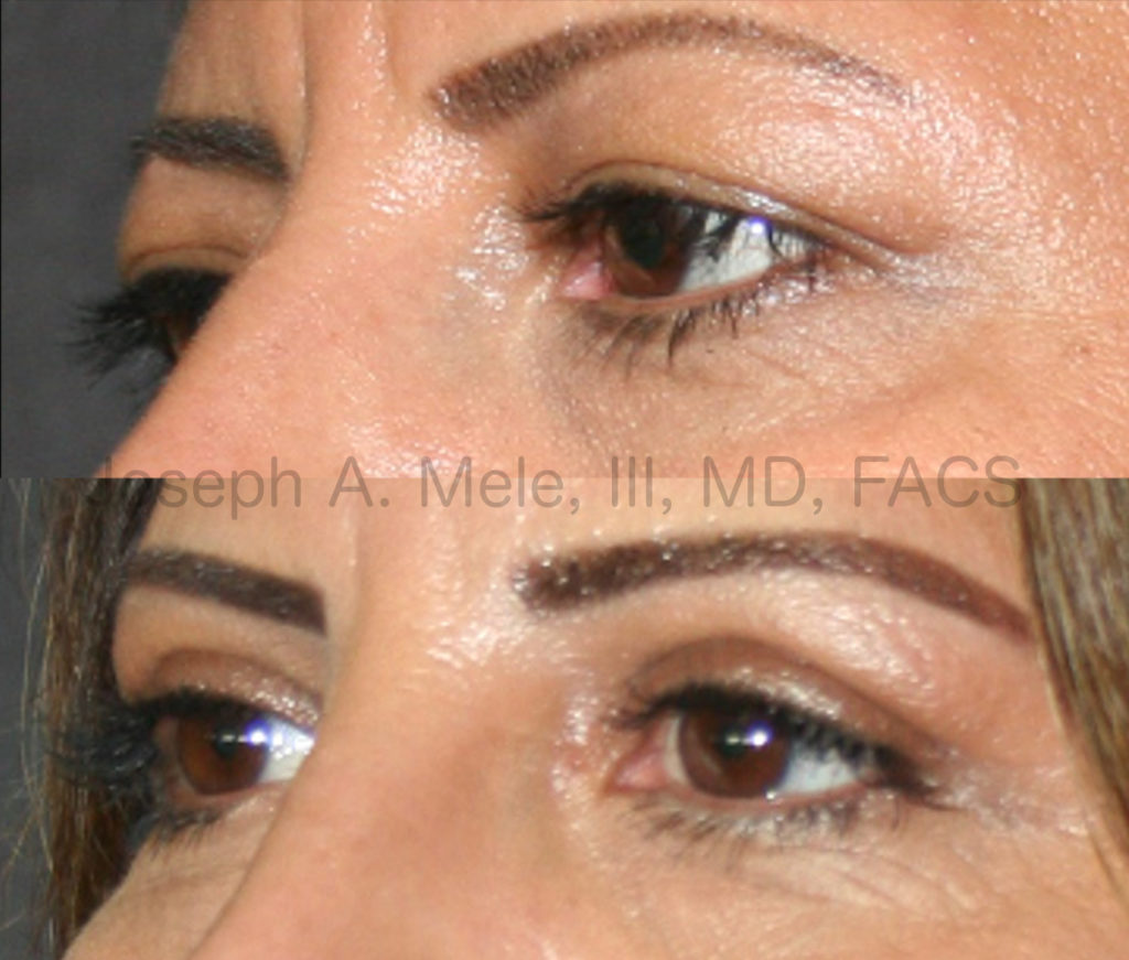 Upper and Lower Blepharoplasty Before and After Pictures: Sagging upper eyelids, caused by excess, upper eyelid skin, leads to a tired and disinterested appearance. Blepharoplasty can open your eyes to a more youthful, bright and alert appearance.