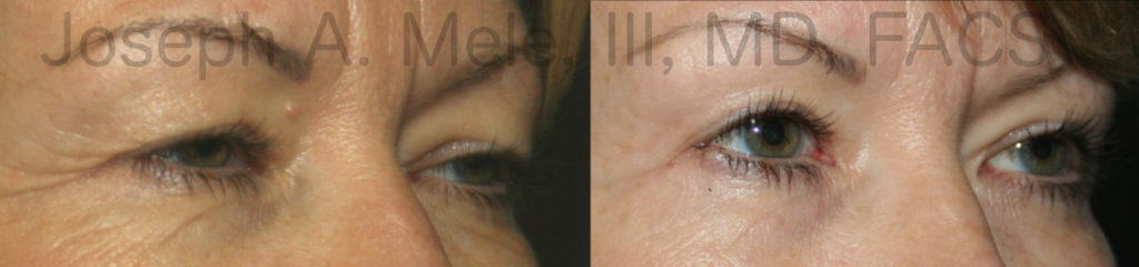 Blepharoptosis (saggy upper eyelids) is corrected with levator advancement in these eyelid surgery before and after photos. 