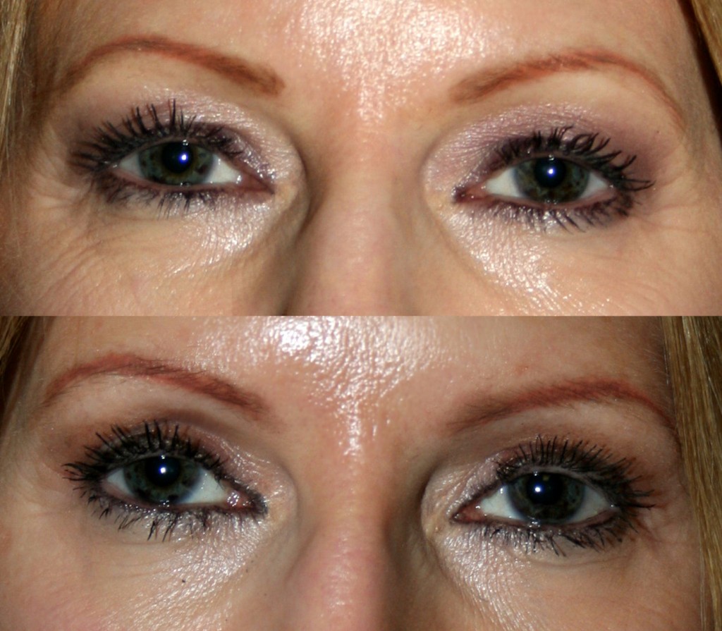 The above upper and lower blepharoplasty (Quad Bleph) before and after photos reveal improvements in the upper and lower eyelids' appearance. Less upper eyelid skin means smoother, cleaner lines and that eye makeup stays put better. Lower eyelid improvements include smoother appearance and less bagging of both skin and lower eyelid fat.