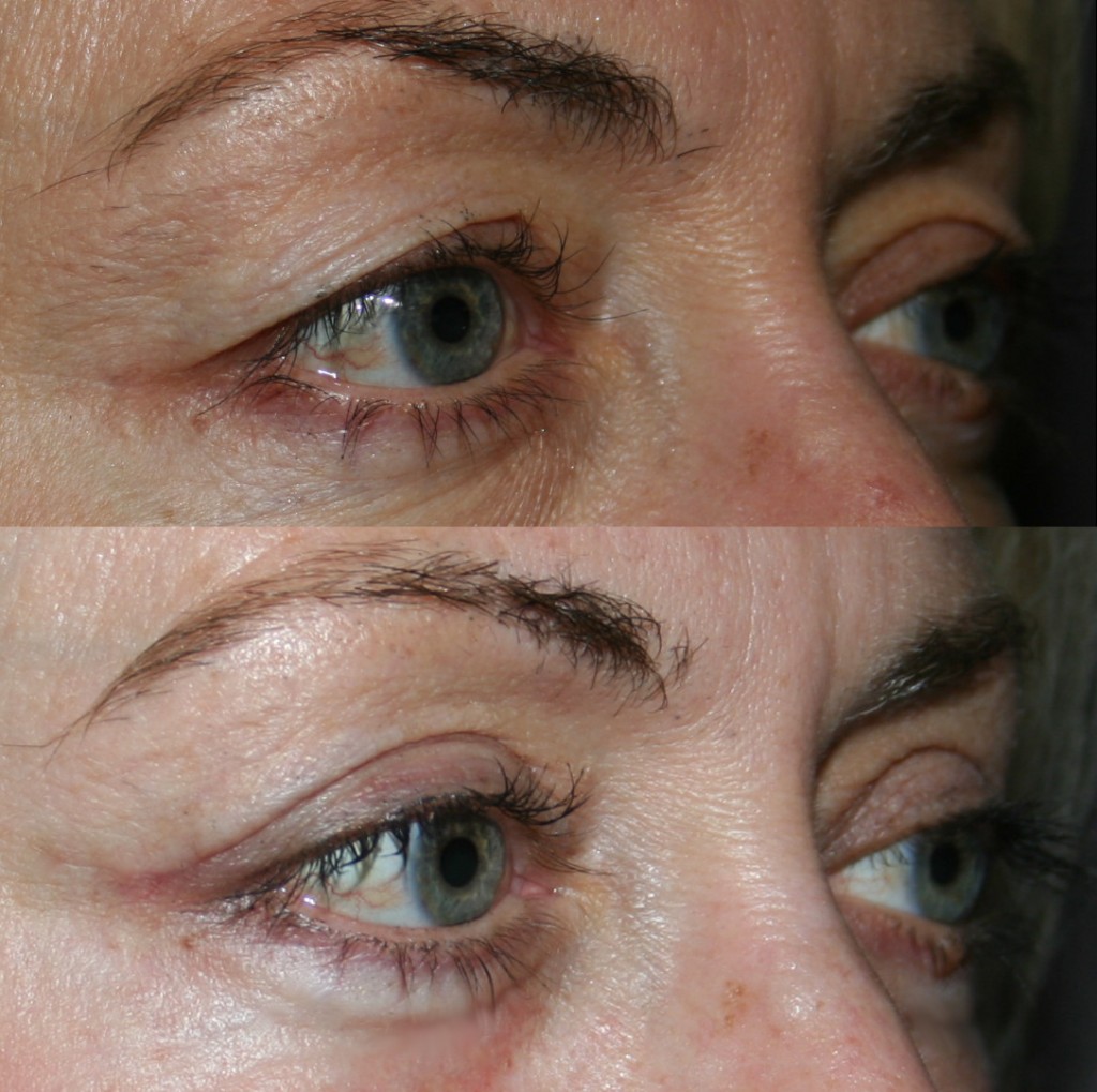 Excess upper eyelid skin gives a tired look. After upper eyelid surgery, the appearance is alert and rested.